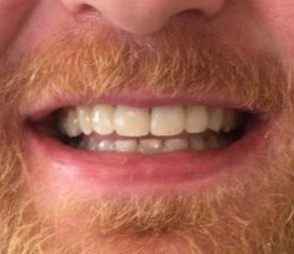 karl-6-month-braces-after